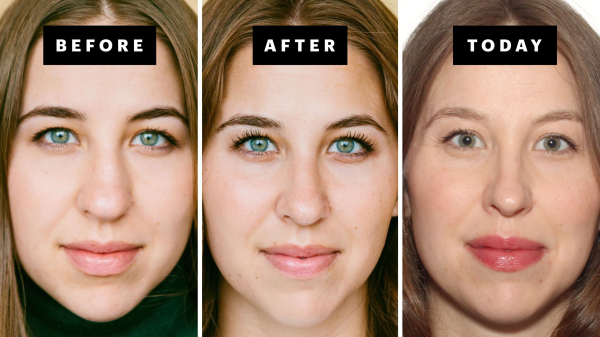 My Rhinoplasty Procedure Story | Nose Before and After Photos